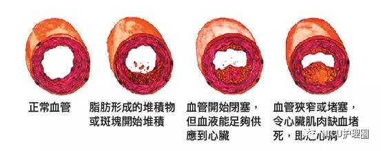 血管堵塞程度图片