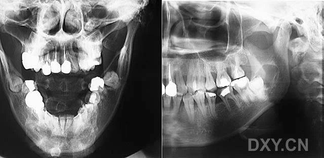 牙源性角化囊腫骨髓炎含牙囊腫牙源性腺瘤樣瘤球狀上頜囊腫(骨端,骨幹