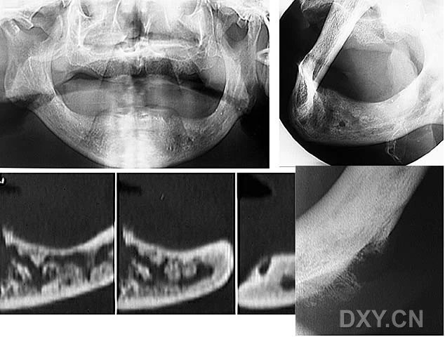 骨髓炎含牙囊腫牙源性腺瘤樣瘤球狀上頜囊腫(骨端,骨幹端及骨幹均有