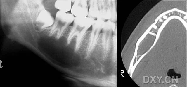 颌骨骨髓炎影像图片