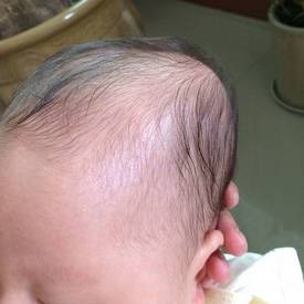 有的新生儿出生后,头部可触摸到一个隆起的包,用手摸感到柔软,压之