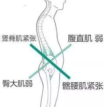 髂腰肌综合征图片