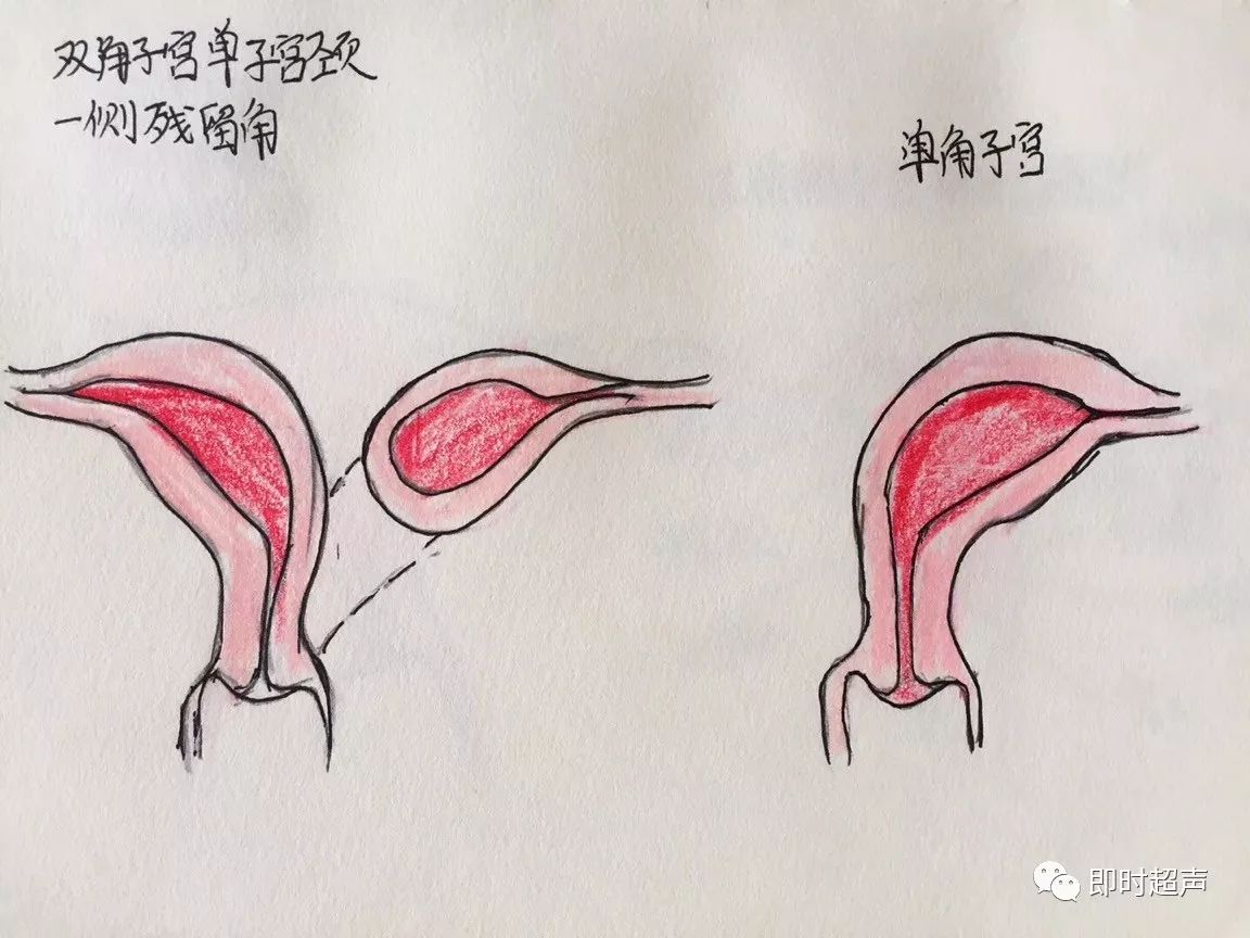 雙角子宮:(1)子宮底部有明顯凹陷,形成分開的兩個子宮角;內可見子宮