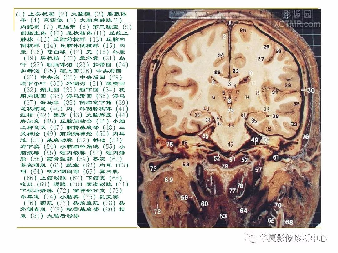 顱腦的斷層解剖記不住那麼你需要收藏下這個