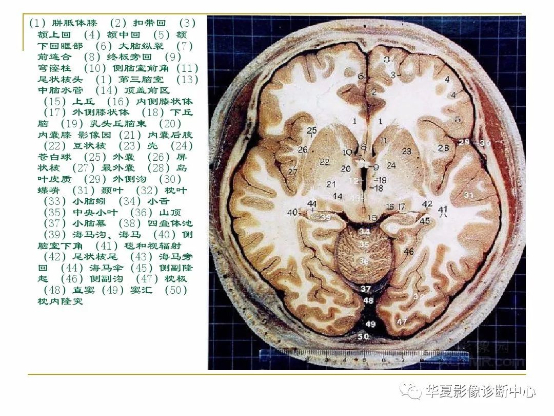 顱腦的斷層解剖記不住那麼你需要收藏下這個