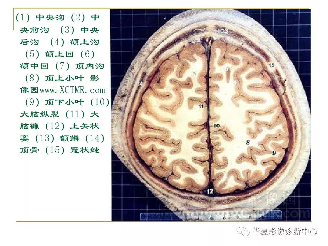 顱腦的斷層解剖記不住那麼你需要收藏下這個