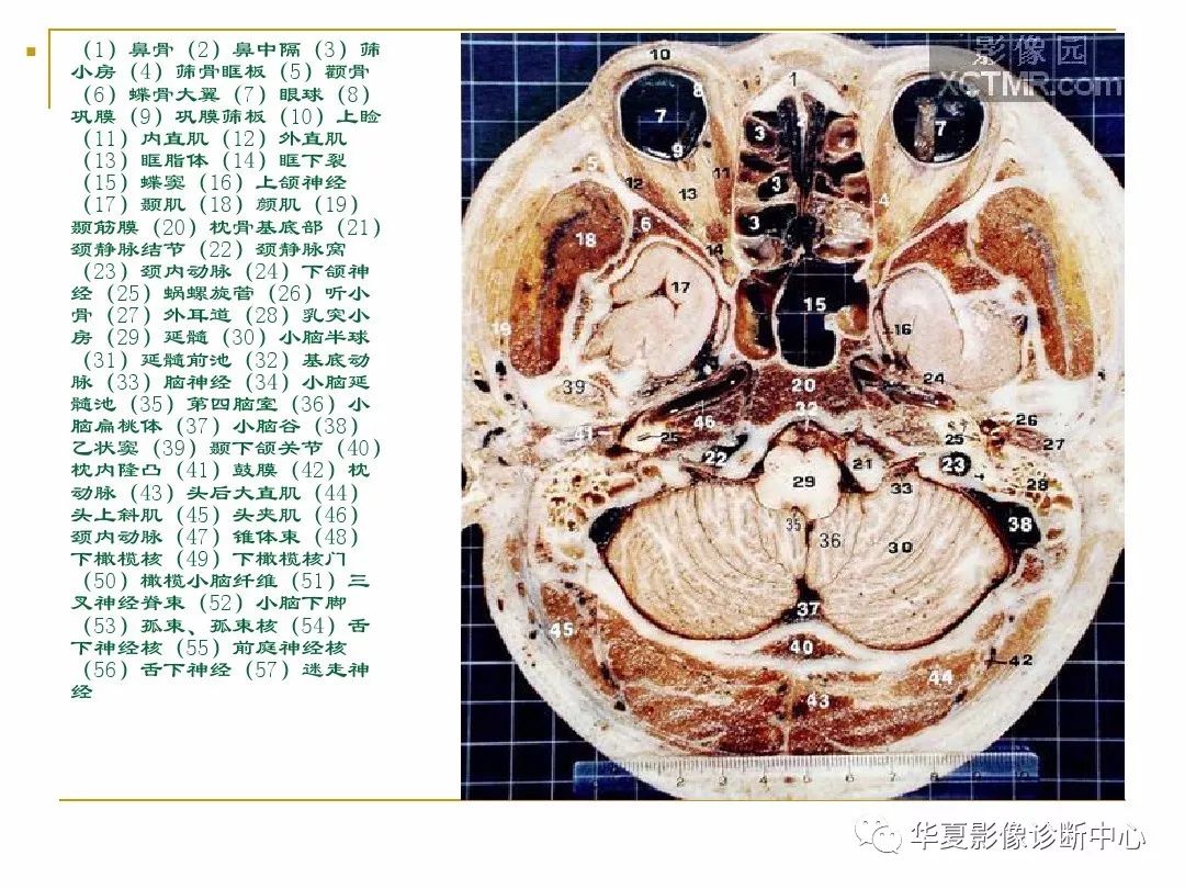 顱腦的斷層解剖記不住那麼你需要收藏下這個