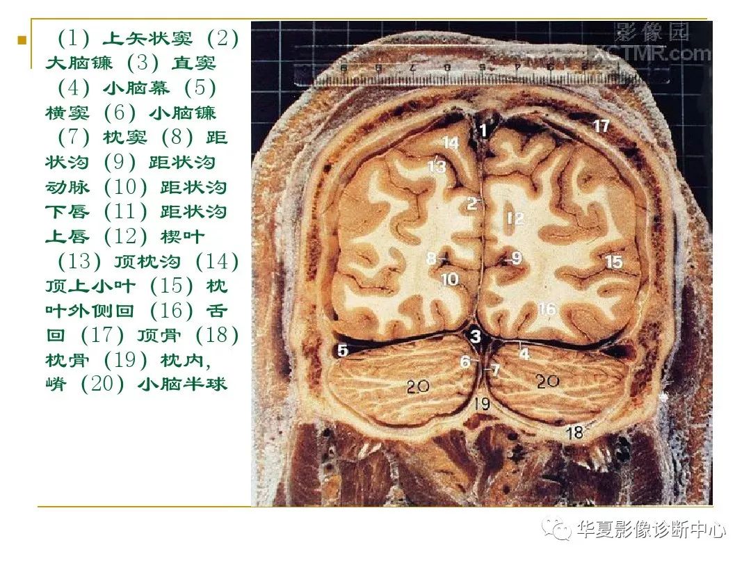 顱腦的斷層解剖記不住那麼你需要收藏下這個
