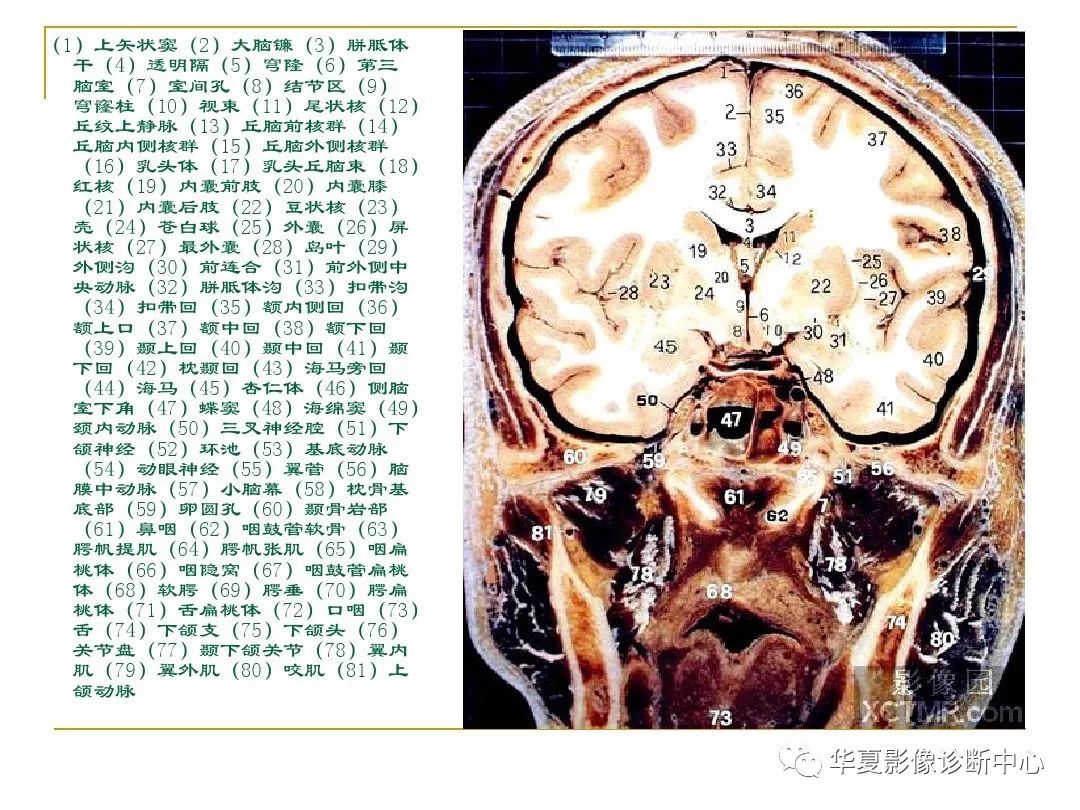 头颅正面解剖图图片