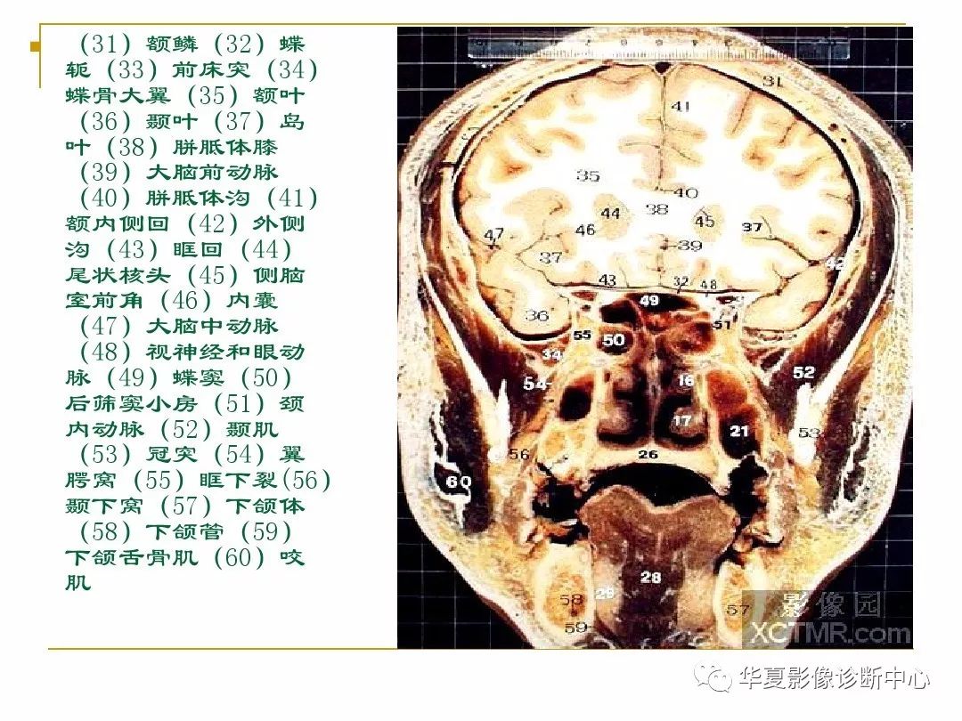 顱腦的斷層解剖記不住那麼你需要收藏下這個