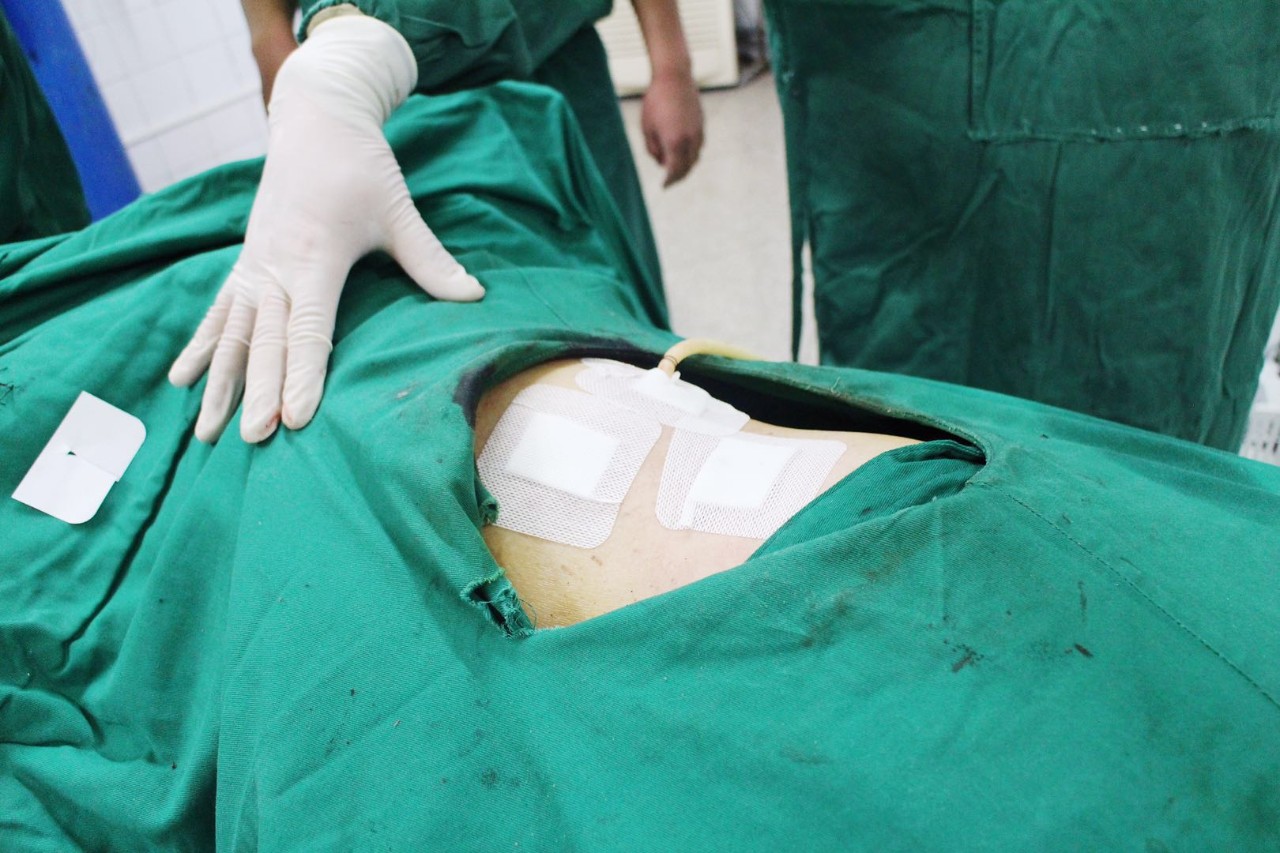 高阳县中医院我院外一科成功完成腹腔镜下左肾囊肿去顶减压术