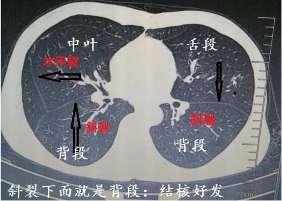 左肺上叶尖后段图片图片