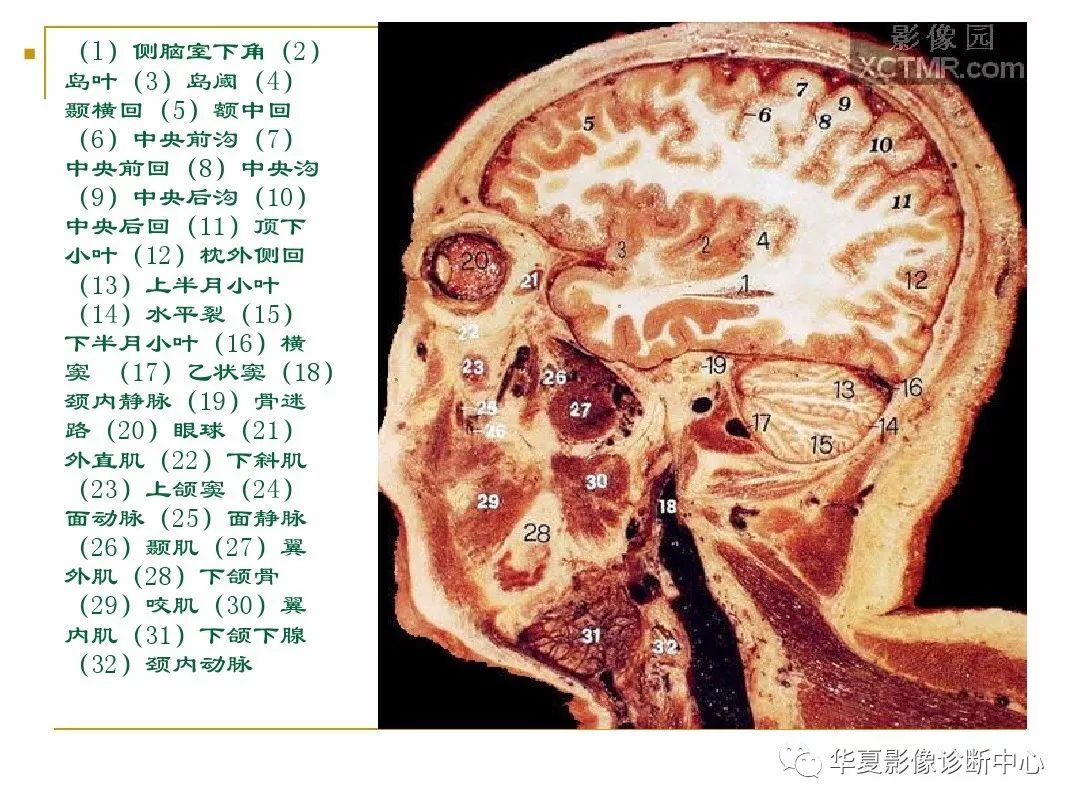 顱腦的斷層解剖記不住那麼你需要收藏下這個