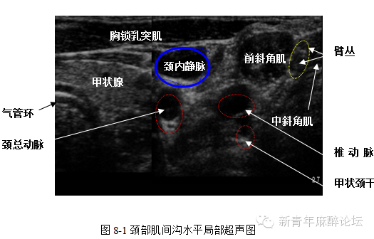 臂丛神经阻滞超声图片