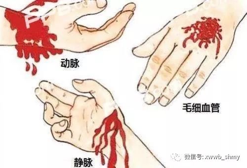 手大动脉出血图片图片