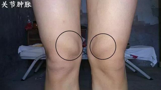 膝盖滑膜炎图片外观图片
