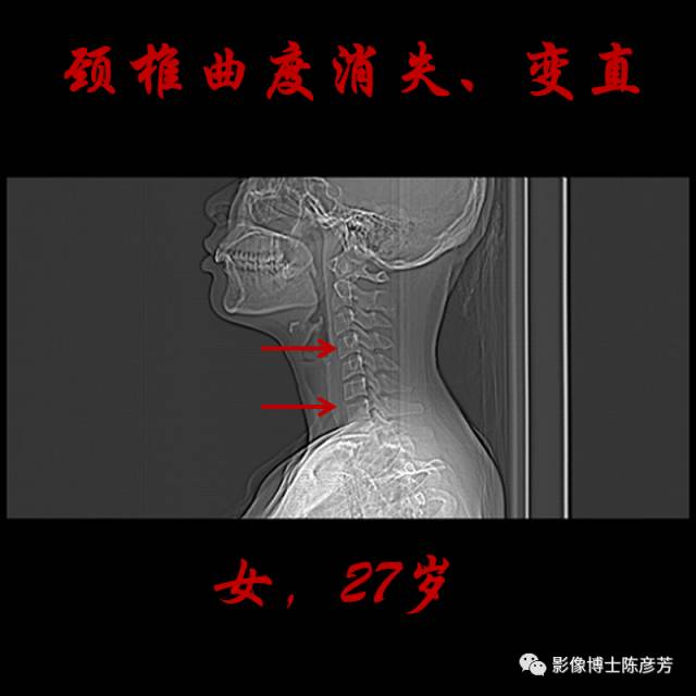 颈椎曲度消失了,怎么回事?