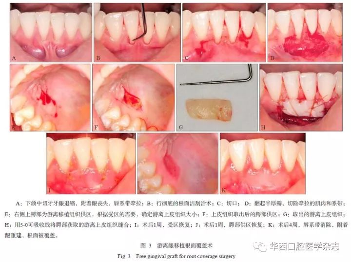 膜龈联合界图片