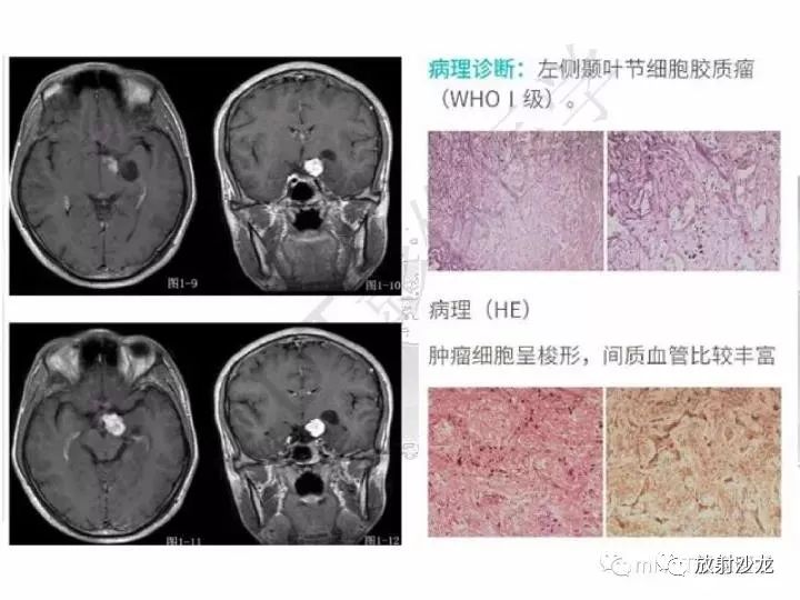 顱內節細胞膠質瘤的mri診斷