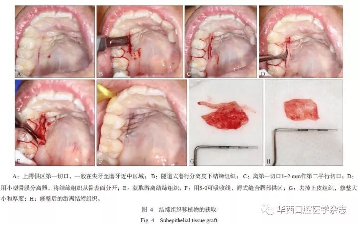 冠周龈瓣切除术图片