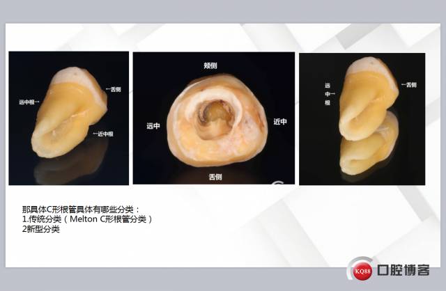 c形根管形态图片