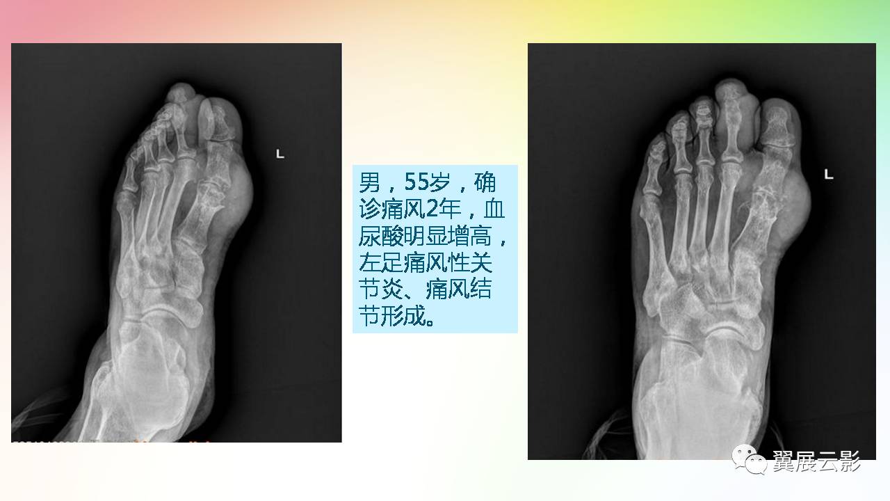 痛风性关节炎与假性痛风性关节炎x线诊断