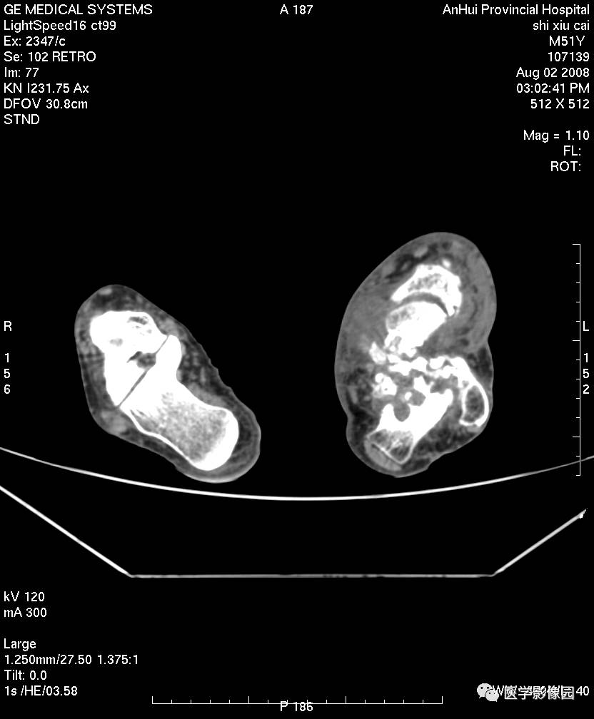 沿关节面可见虫噬样骨质破坏,并可见沙粒样死骨,周围软组织肿胀