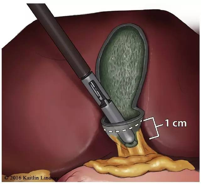 一個有爭議的術式腹腔鏡下開窗法部分膽囊切除術