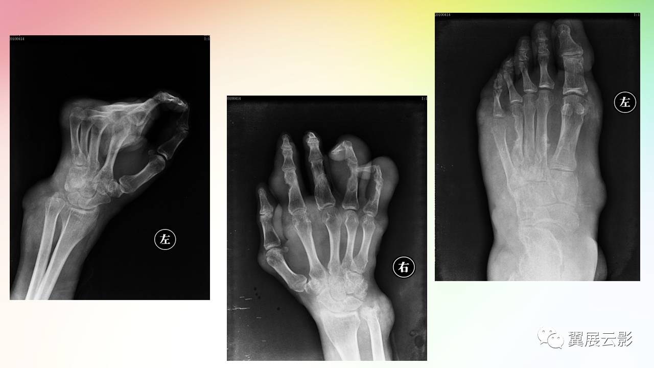 痛风性关节炎与假性痛风性关节炎x线诊断