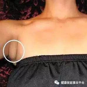 女性副乳疼图片