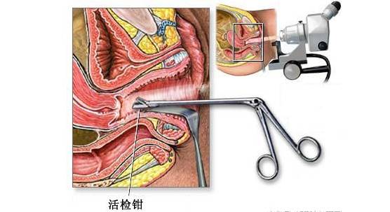 宫颈活检就是子宫颈的活体组织检查,亦即从宫颈上取一小块或几块组织
