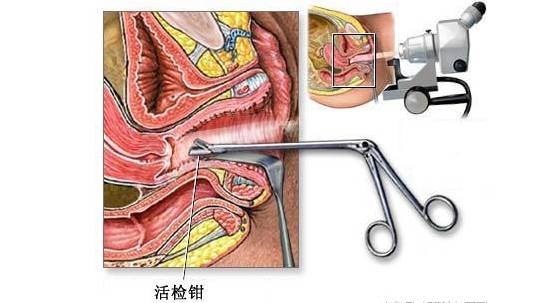 我们就不得不提一项检查方法——宫颈活检