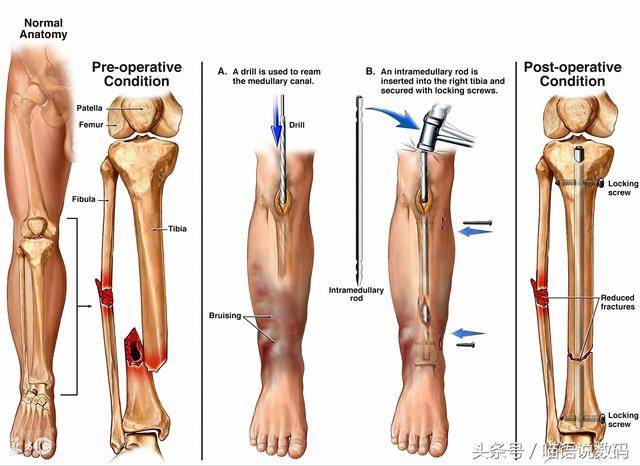 骨折后骨头生长过程图图片