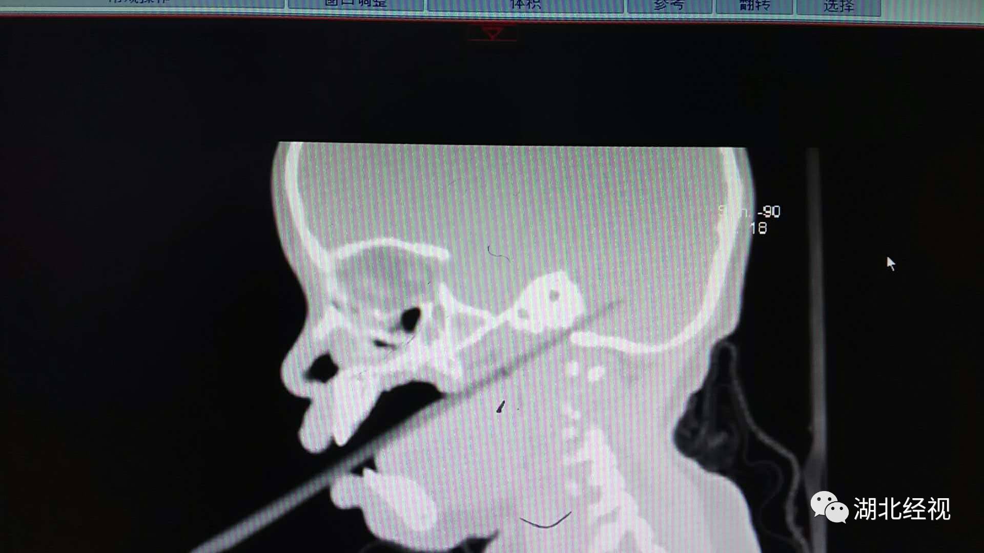 到達武漢兒童醫院,醫生髮現筷子從孩子上顎插入,迅速給孩子做了相關