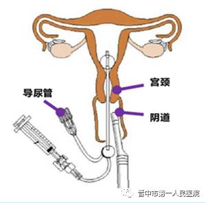 输卵管造影过程图片