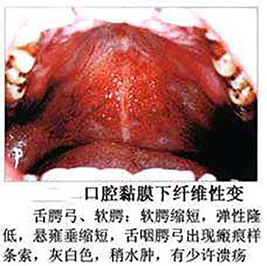 槟榔癌变切嘴的图片图片