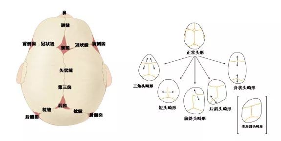 舟状头颅缝早闭图片图片