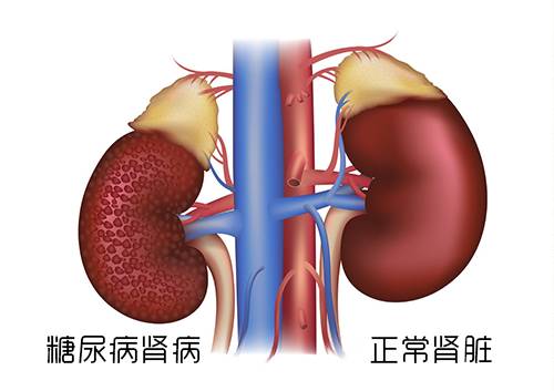 糖尿病只降糖不护肾,当心引发肾衰竭!