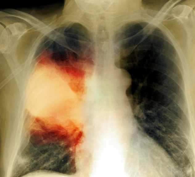 肺癌晚期真实照片图片