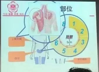 肝素打大腿正确示意图图片