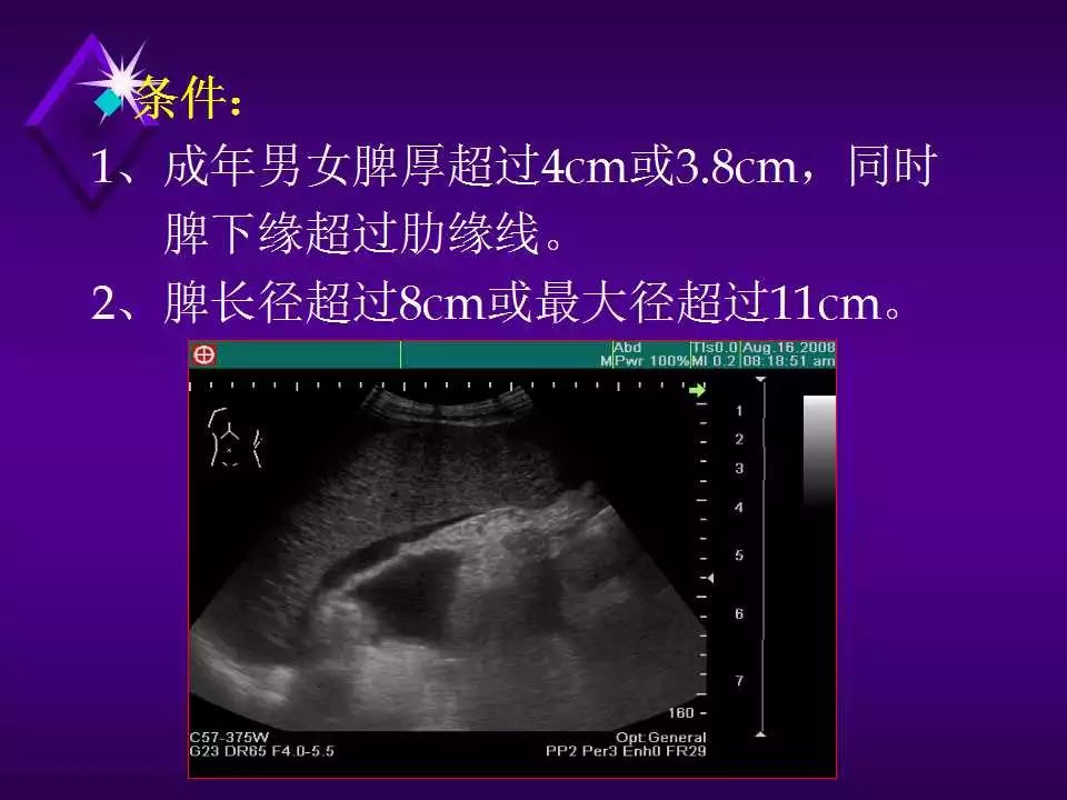 脾脏超声诊断