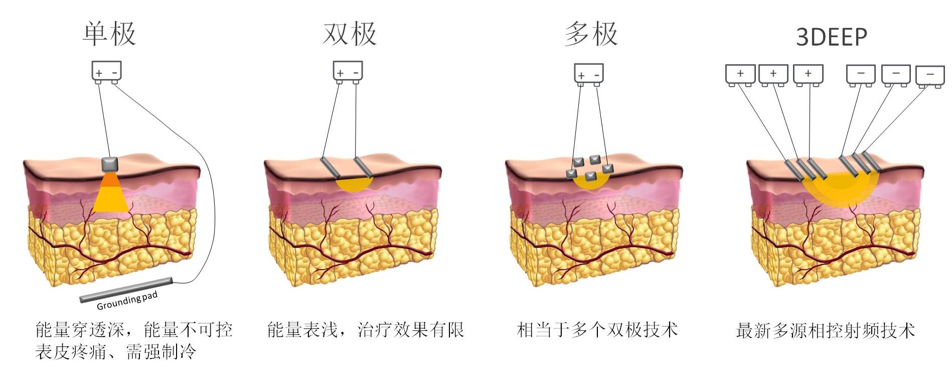 3deep多源相控射频与传统射频有什么区别?