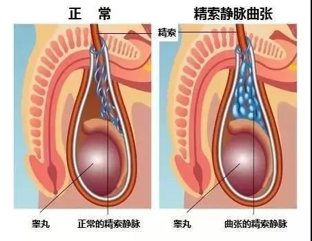 精索静脉曲张图片真人图片