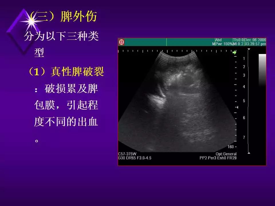 脾破裂超声表现图片