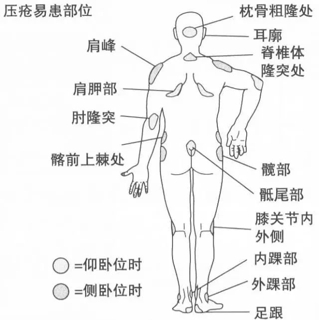 防止压疮1,良肢位摆放的作用:(如果你想进一步了解,记得一定要往下看