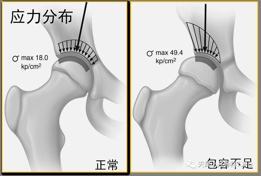 髋臼ce角示意图图片