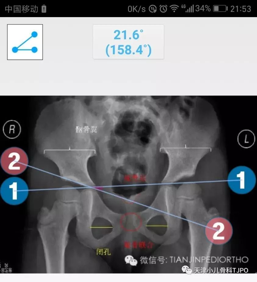 ddh: 2分钟学会测量髋臼指数 量角 测量 角度