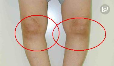 1把丝瓜籽顶10副药专治滑膜炎用一个好一个膝盖疼的的存