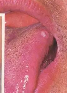 舌菌状乳头立起来图片
