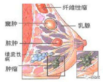 乳腺结节图解图片